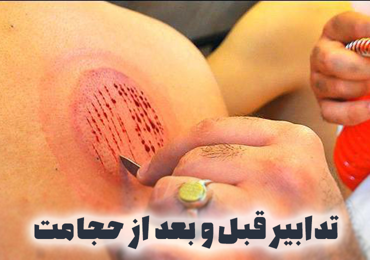 تدابیر حجامت